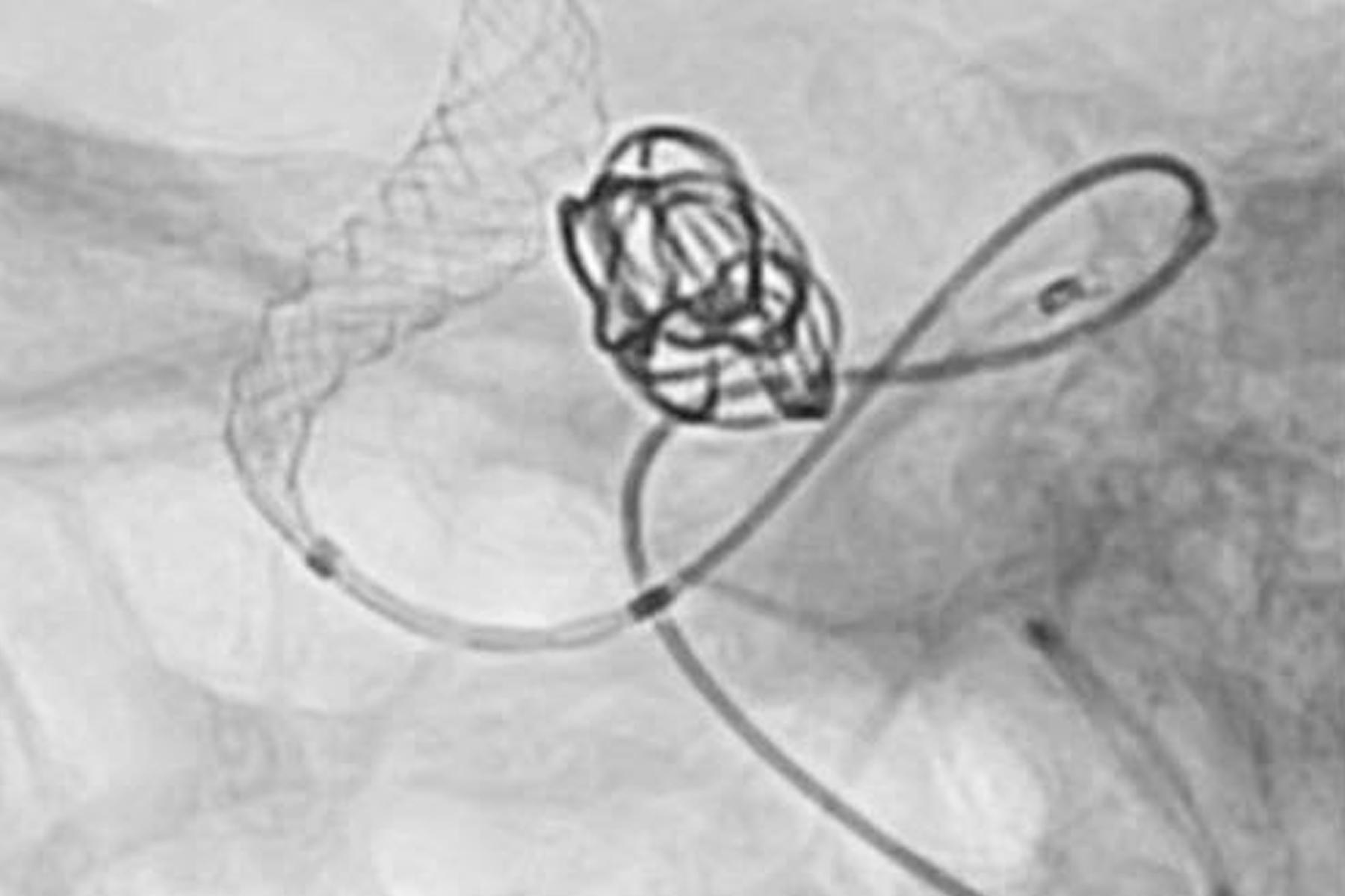 DISTAL ACCESS CATHETER 7